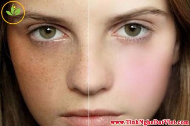 Tuyệt chiêu trị tàn nhang bằng mặt nạ tinh bột nghệ