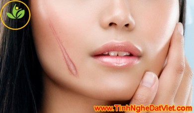 Phương pháp điều trị sẹo sau tai nạn, hiệu quả đến 80 %